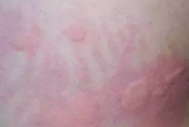 天干气躁小心皮肤过敏