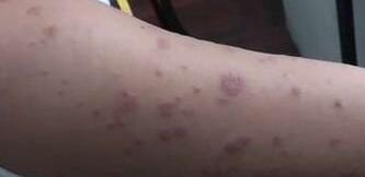 冬季怎么预防季节性湿疹
