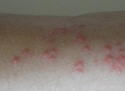 夏季皮肤过敏起红疹怎么办